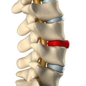 Causes and Treatments of Herniated Discs